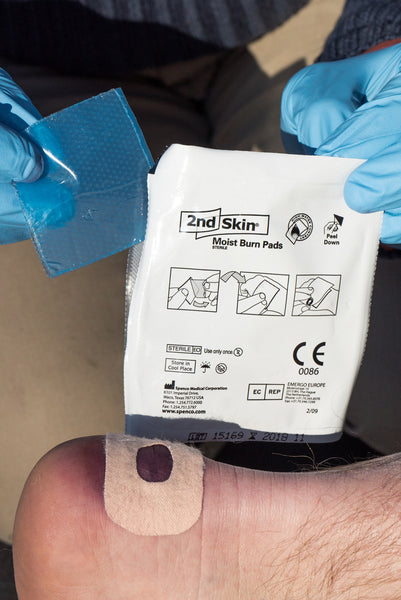 2nd Skin Burn Dressing being applied to a wound, showing blue medical gloves handling the packaging and demonstration of the transparent protective gel bandage on skin with application instructions visible on the product packet